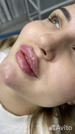 Увеличение губ