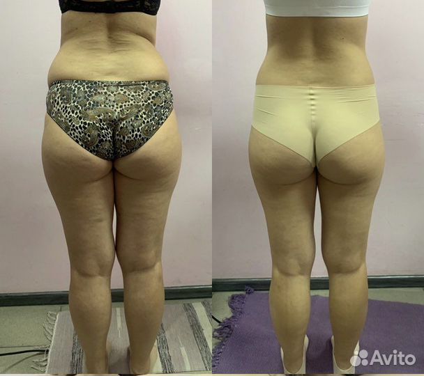 LPG массаж на аппарате B-Flexy