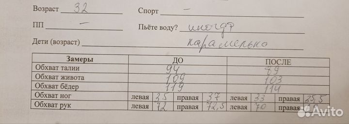 Карамельная липосакция