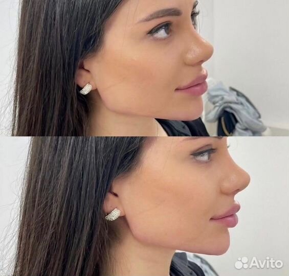 Углы Джоли. Услуги косметолога в рассрочку