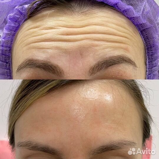 Ботокс для лица