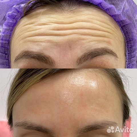 Ботокс для лица