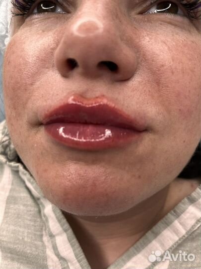 Косметолог /увеличение губ/ботокс