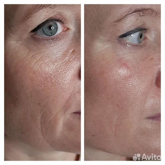 СМАС лифтинг