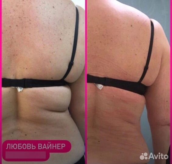 RF вакуумный массаж