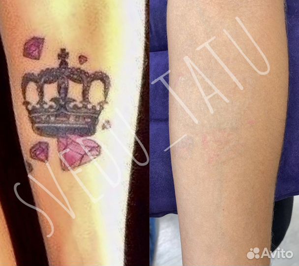 Лазерное удаление татуировок и татуажа Пирсинг