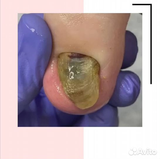 Медицинский педикюр