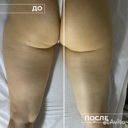 Модель на аппаратный массаж тела для похудения