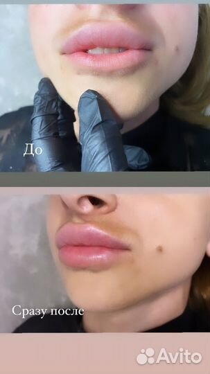 Коррекция губ