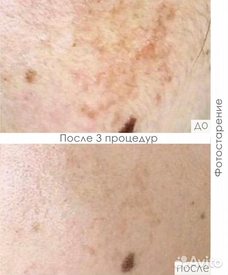 DermaQues «мангобрайт» Набор на 4 процедуры