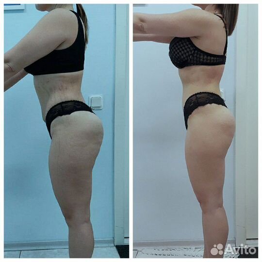 LPG массаж, RF лифтинг, миостимуляция, кавитация