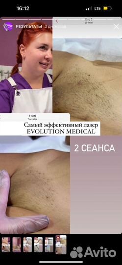 Лазерная эпиляция