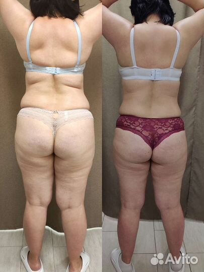 Модель на аппаратные методики коррекции фигуры