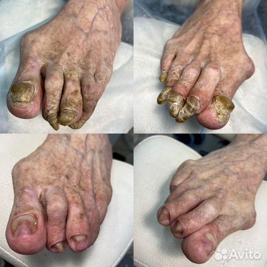 Подолог (педикюр)