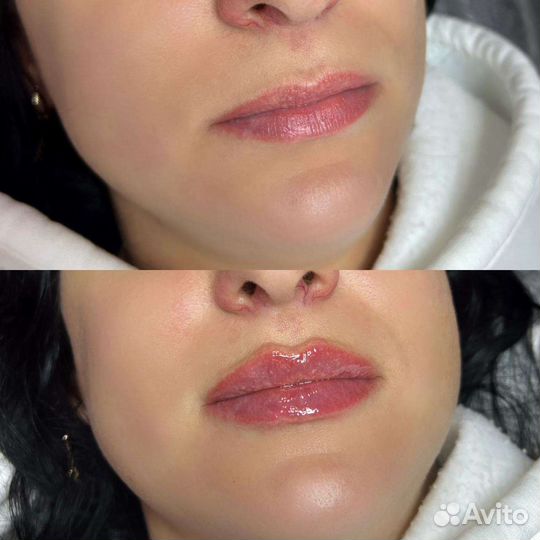 Биоревитализация