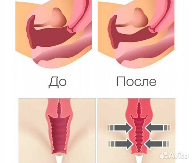 Интимное омоложение. Увеличение точки G