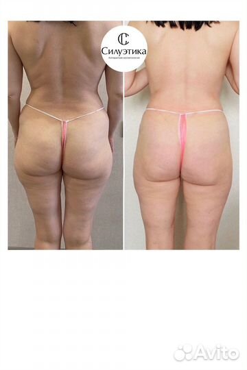 Массаж для похудения, Антицеллюлитный, роликовый