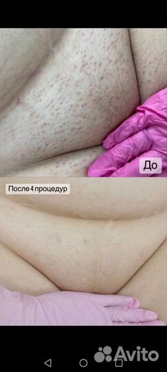 Лазерная эпиляция