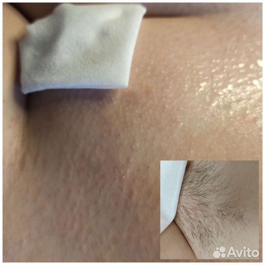 Шугаринг и ваксинг