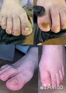 Лечение ногтей на ногах, подолог