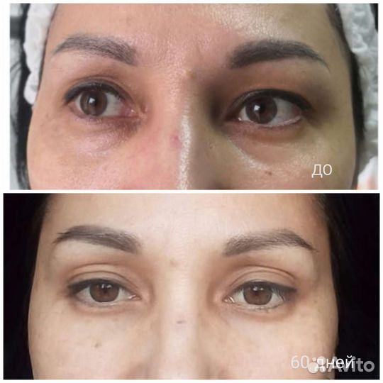 Блефаропластика без операции, нависшее веко, мешки