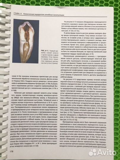 Эндодонтия Рикуччи