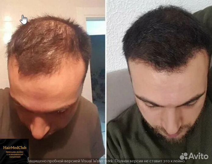 Пересадка волос, бороды Россия/ Турция