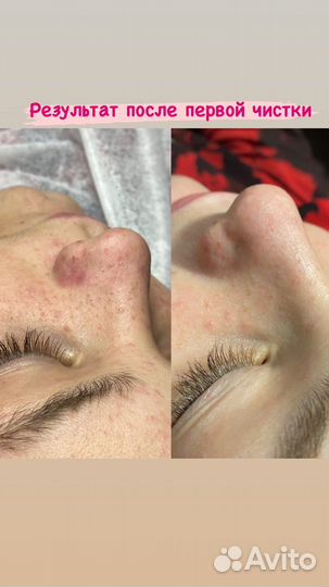 Механическая чистка лица