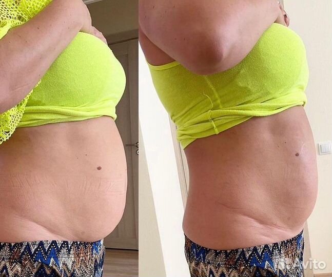 Коррекция фигуры Липосоникс -3см за одну процедуру