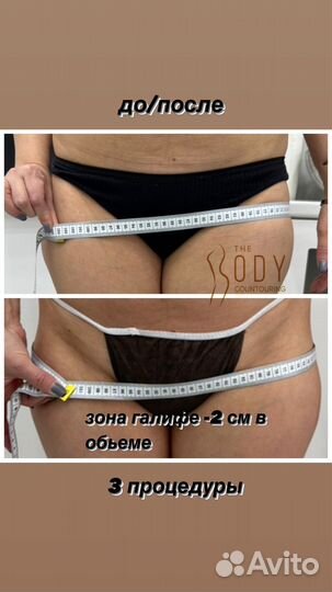 Процедура Индиба