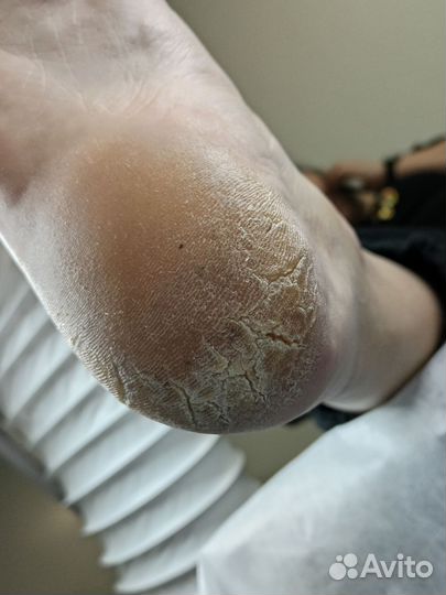 Медицинский педикюр