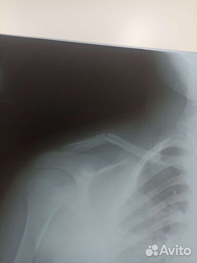 Кольца Дельбе Бандаж Реклинатор ортопедический