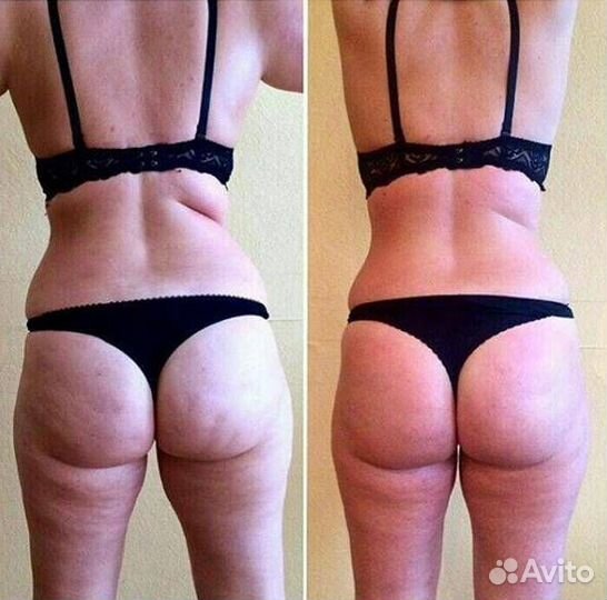 Антицеллюлитный массаж