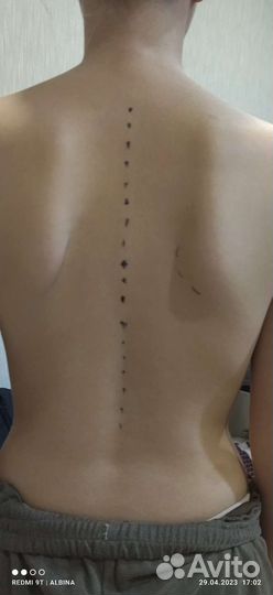 Массаж кинезио, Здоровая спина, пиявки