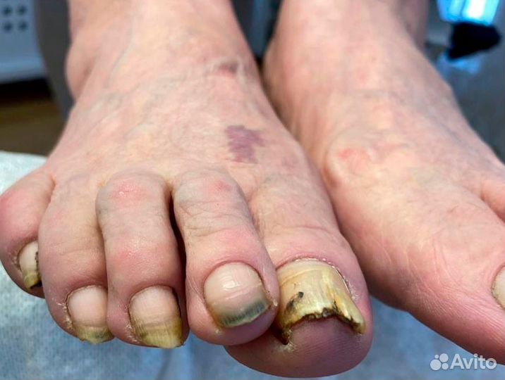 Медицинский педикюр - Подолог