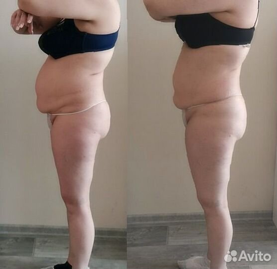 LPG-массаж тела и лица