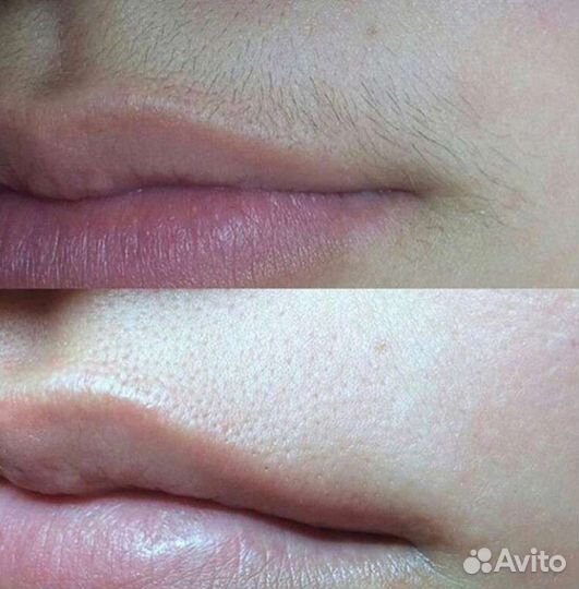 Шугаринг, депиляция