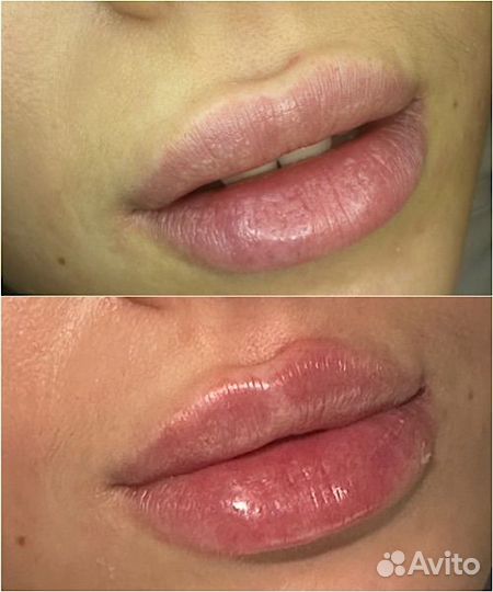 Контурная пластика губ