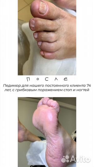 Подология, мозоли, трещины, вросшие ногти