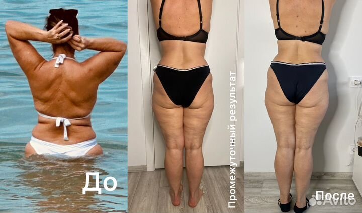 Антицеллюлитный массаж