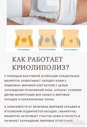 Липосакция коррекция фигуры криолиполиз