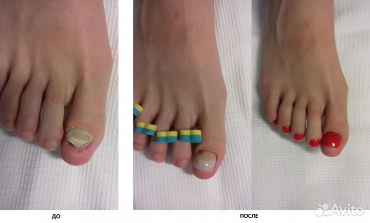 Медицинский маникюр педикюр Восстановление ногтей