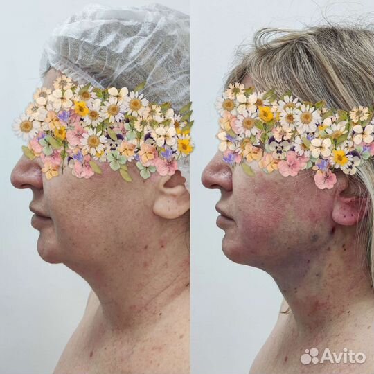 Удаление второго подбородка навсегда