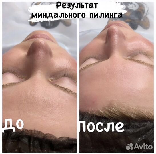 Косметология, Шугаринг