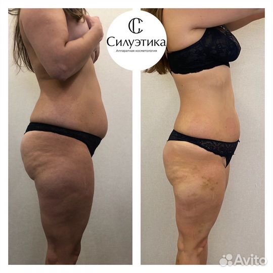 Массаж для похудения, Антицеллюлитный, роликовый