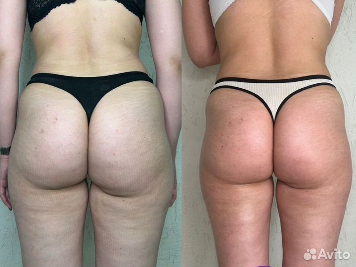 Аппаратный массаж