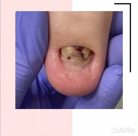 Медицинский педикюр