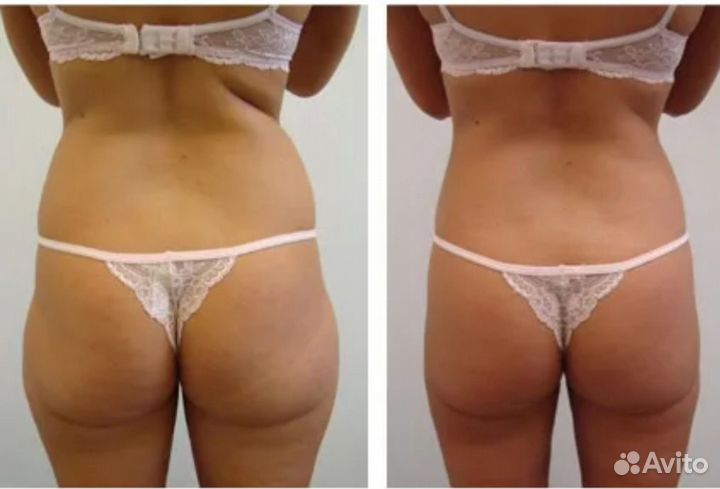 Антицеллюлитный массаж