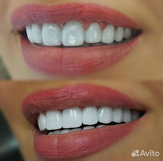 Голивудская улыбка