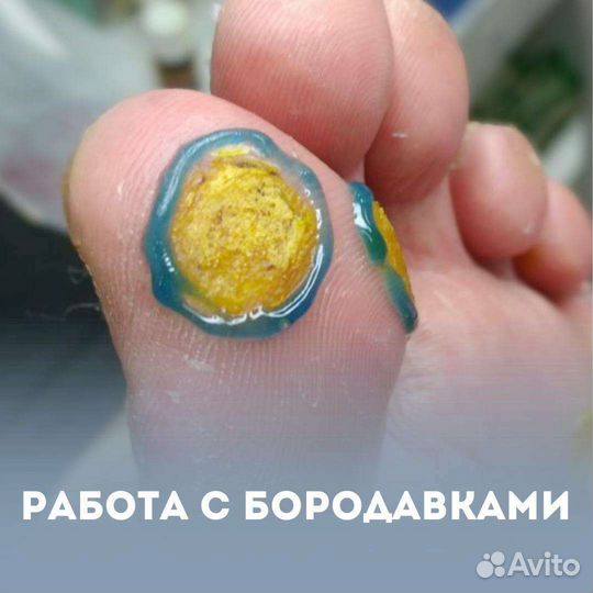 Медицинский педикюр подолог